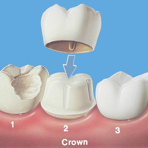 Зубные коронки